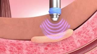 How GAINSWave Solves Peyronies Disease