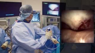 Flexible Ureteroscopy with Dr. Sur, Small Stone Procedure