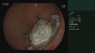 EFTR Endoscopic Full Thickness Resection procedure by Dr  Y Rami Reddy Gastroenterologist