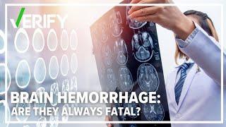 No, a brain hemorrhage is not always fatal