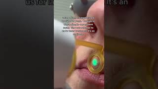 Treating “spot” on face with laser #shorts