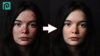 How to Remove Acne and Soften Skin in Photopea | High-End Skin Softening | Remove Pimples