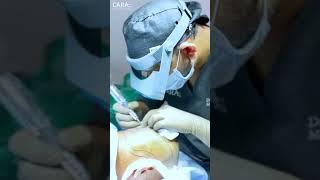 Viral Hair Transplant Surgery at Cara Clinic