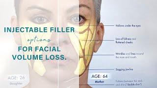 Injectable Facial Fillers for Volume Loss | Hyaluronic Facial Fillers