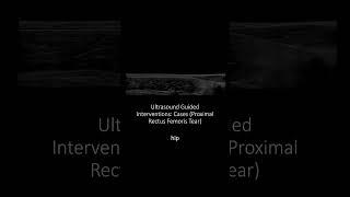 #Ultrasound Guided Interventions: Cases (Proximal Rectus Femoris Tear)