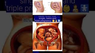 #single, twins and triplets pregnancy।।।। difference among single, twins and triple pregnancy.