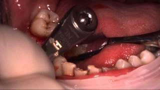 C-TECH EL Implant Live Protocol