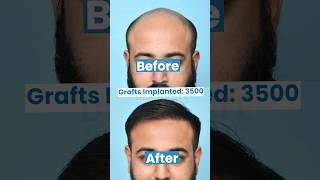 Hair Transplant Result After 8 Months | 3500 Grafts of Hair Transplant with Boosted FUE Technique