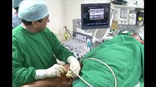 Treatment of Varicose Veins with Radio Frequency Ablation (RFA)- Dr Shoaib Padaria