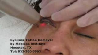 Laser Tattoo Removal - Eyeliner Tattoo