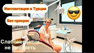 #имплантациязубов Поставили 9 зубных имплантов в Турции. Подробный отчет за 4 дня после Имплантация
