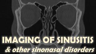 Imaging Findings in Acute & Chronic Sinusitis (including Polyposis & Sinonasal Tumors)