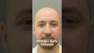 5000 Grafts Hair Transplant with Sapphire FUE Method