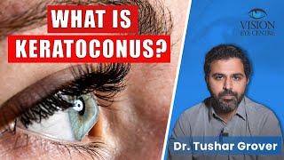 What is Keratoconus? | Keratoconus Treatment | Keratoconus Eye Disease Explained!