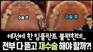 다른 곳에서 한 임플란트도 있고, 잇몸에서 피도 나요ㅠㅠ 금속도 비춰보이는 상황.. 다 뜯고 임플란트 재수술?! NOPE ! 지대주와 보철물만 교체! 음식물도 덜끼고 심미적으로!