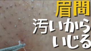 【角栓やら】眉間の毛穴が汚かった角栓取ったり極稀に毛を抜いたり。