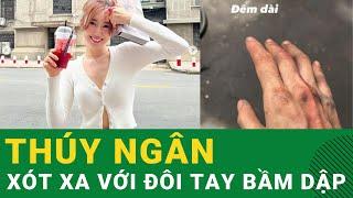 Thúy Ngân khiến fan xót xa với đôi tay bầm dập không rõ lý do