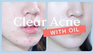 Debunking Acne Myths: How to treat acne with oils | KraveBeauty Oil La La