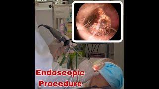 Endoscopic earwax removal Procedure | Doctor Anh