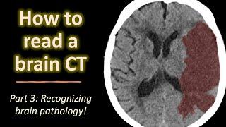 How to read a brain CT (part 3): acute brain pathology