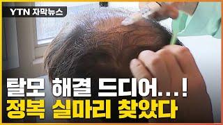 [자막뉴스] 탈모 정복 실마리 찾았다...국내 연구진이 개발한 신기술 / YTN