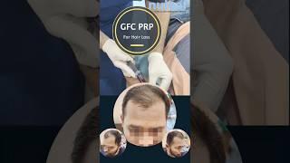 GFC using Plasma for treatment hair loss | Hair Growth after 4 sessions | Androgenetic Alopecia