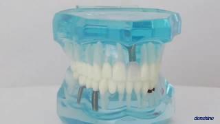 Dental Study Tooth Transparent Adult Pathological Teeth Model