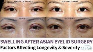 Temporary Swelling after Asian Double Eyelid Surgery - Factors that Affect Severity Healing Time