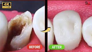 AMAZING Premolar Root Canal Treatment #asmr