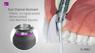 Dual Channel Abutment