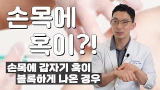 손목에 혹이?! / 손목에 갑자기 혹이 볼록하게 나온 경우