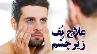 علت پف زیر چشم و رابطه اش با کمبود کدام ویتامین ها