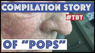 "Pops" and his BEST blackhead extractions - TBT