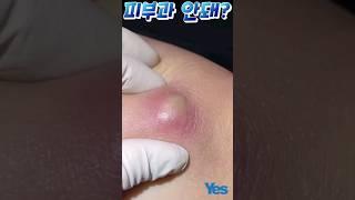 피부과에서 피지낭종 수술이 안된대요 part1