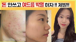 10년된 여드름 딱 3가지 방법으로 극복!! 집에서 이것만 하자!!(더이상 큰 돈 쓰지 말아요!) My journey to get rid of acne!