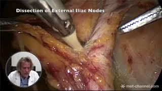 Laparoscopic systematic pelvic lymphadenectomy by Dr. Marcello Ceccaroni, MD., Ph.D