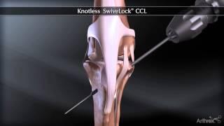 Knotless Swivelock® CCL