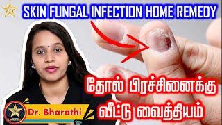 தோல் பிரச்சினை | சருமத் தொற்று | தோல் நோய் | பூஞ்சை தொற்று | தேமலுக்கு சிகிச்சை - Dr Bharathi