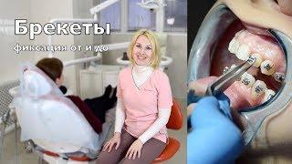 Брекеты – фиксация или как исправить прикус | braces on | ортодонтия Самара влог