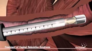 Asclepion MCL31 Vaginal treatment promotional video