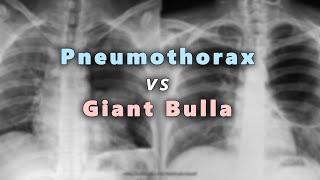 Pneumothorax  vs Giant Bulla in Chest X Ray (Part 6)