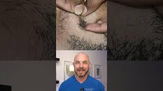 Doctor reacts to huge ingrown hair removal! #dermreacts #doctorreacts #ingrownhair