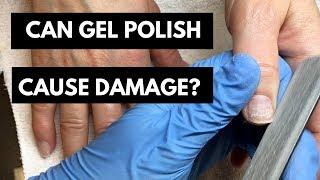 White Spots | Nail Surface Damage | Very uncomfortable topic 