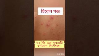 chicken pox #dermatologist #skinspecialist #doctor #health #bangla #birbhum