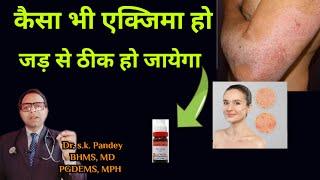 कैसा भी एक्जिमा क्यों न हो , जड़ से ठीक करें Dr. s.k. Pandey BHMS, MD