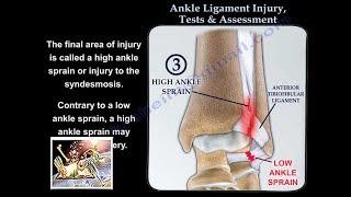 Ankle Ligament Injury, evaluation and tests - Everything You Need To Know - Dr. Nabil Ebraheim