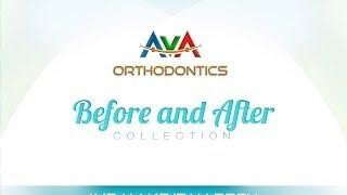 AvA Orthodontics & Invisalign - Before & After Collection