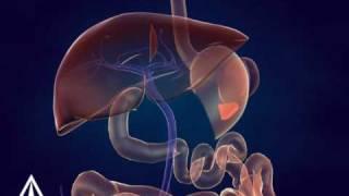 Whipple Procedure - 3D Medical Animation