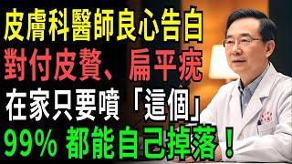 現任醫師揭露：只要噴「這個」 皮贅、扁平疣就會自己掉下來？ 耗費30年研究出的真實除疣法 今天首次完整公開！ #皮膚健康 #除疣方法 #醫師推薦 #天然療法