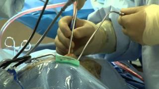Doctors perform brain surgery through the nose